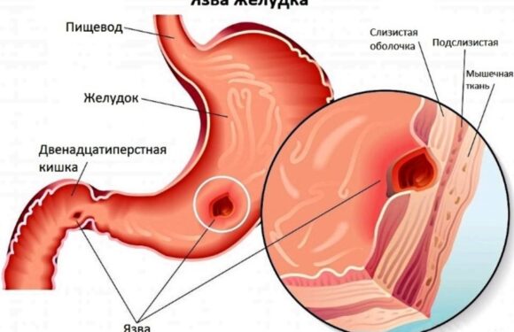 Язва желудка: симптомы и лечение препараты