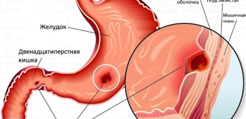 Язва желудка: симптомы и лечение препараты
