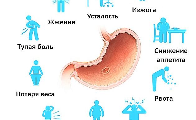 Язва двенадцатиперстной кишки симптомы