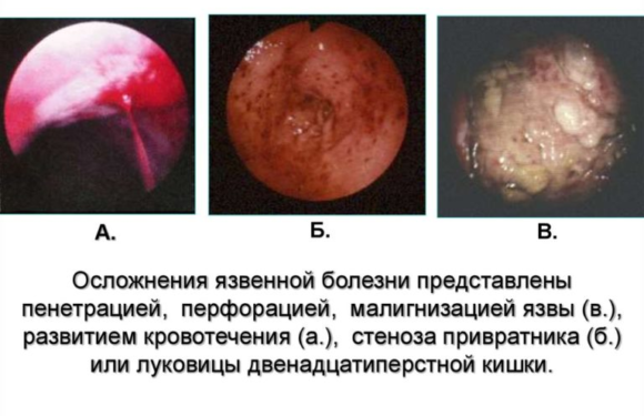 Язва: диагностика и осложнения