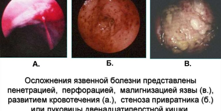 Лечение язвы: методы и советы